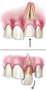 dislodged tooth